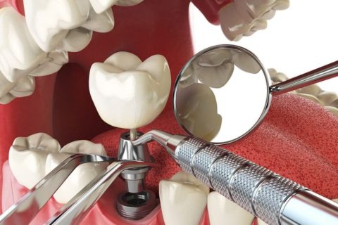 علاج زرع الاسنان