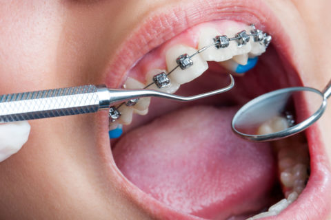 علاج تقويم الأسنان