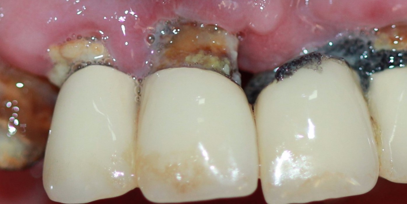 Ağız Kokusu Nedir? Ağız Kokusu Nasıl Geçer? Veske Diş Kliniği