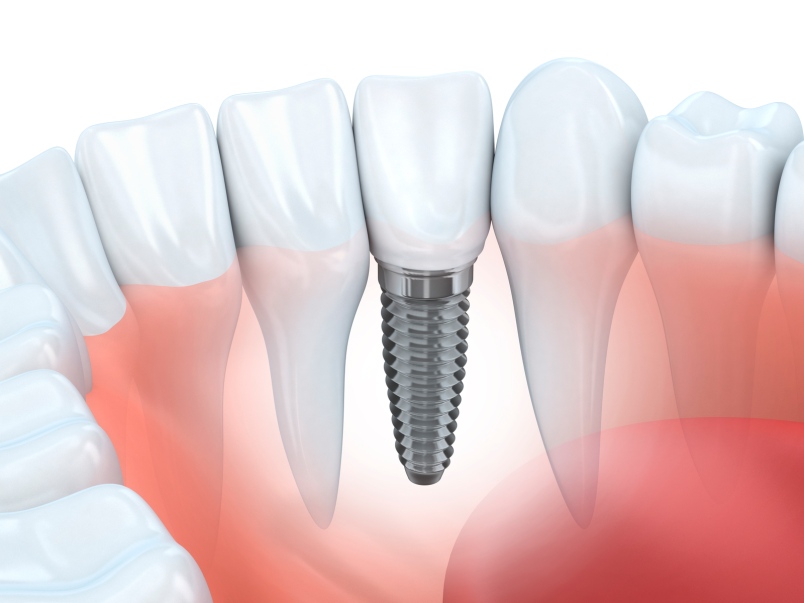 علاجات زرع الاسنان - طبيب أسنان مانافجات الجانب
