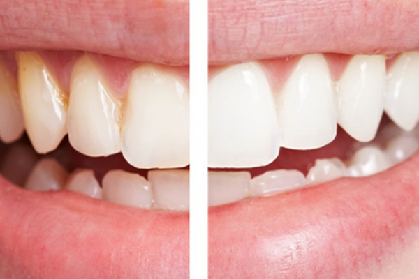 Teeth Whitening Bleaching in Turkey