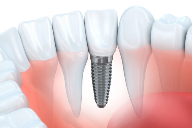 Dental Implants and 3. Dental Period