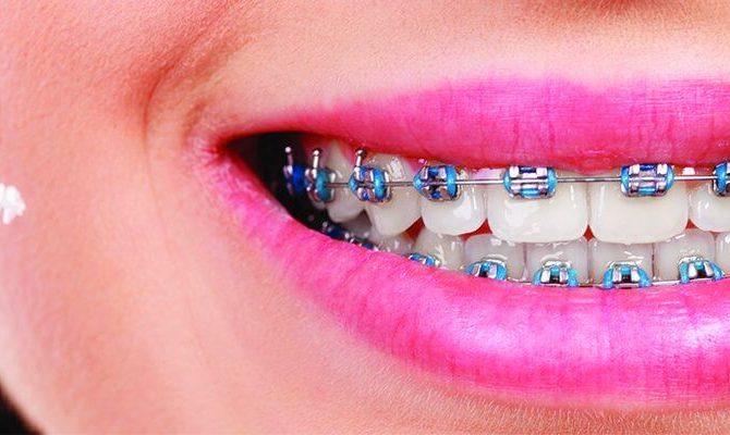 Kaj je ortodontija? - Zobozdravnik Manavgat stran