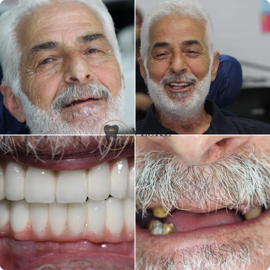 All on six dental implant - Veskedent Dental Implant Turkey