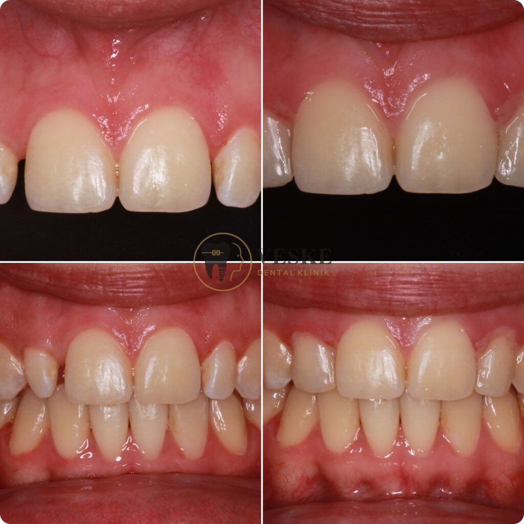 Composite bonding front teeth - Veskedent Dental Implant Turkey