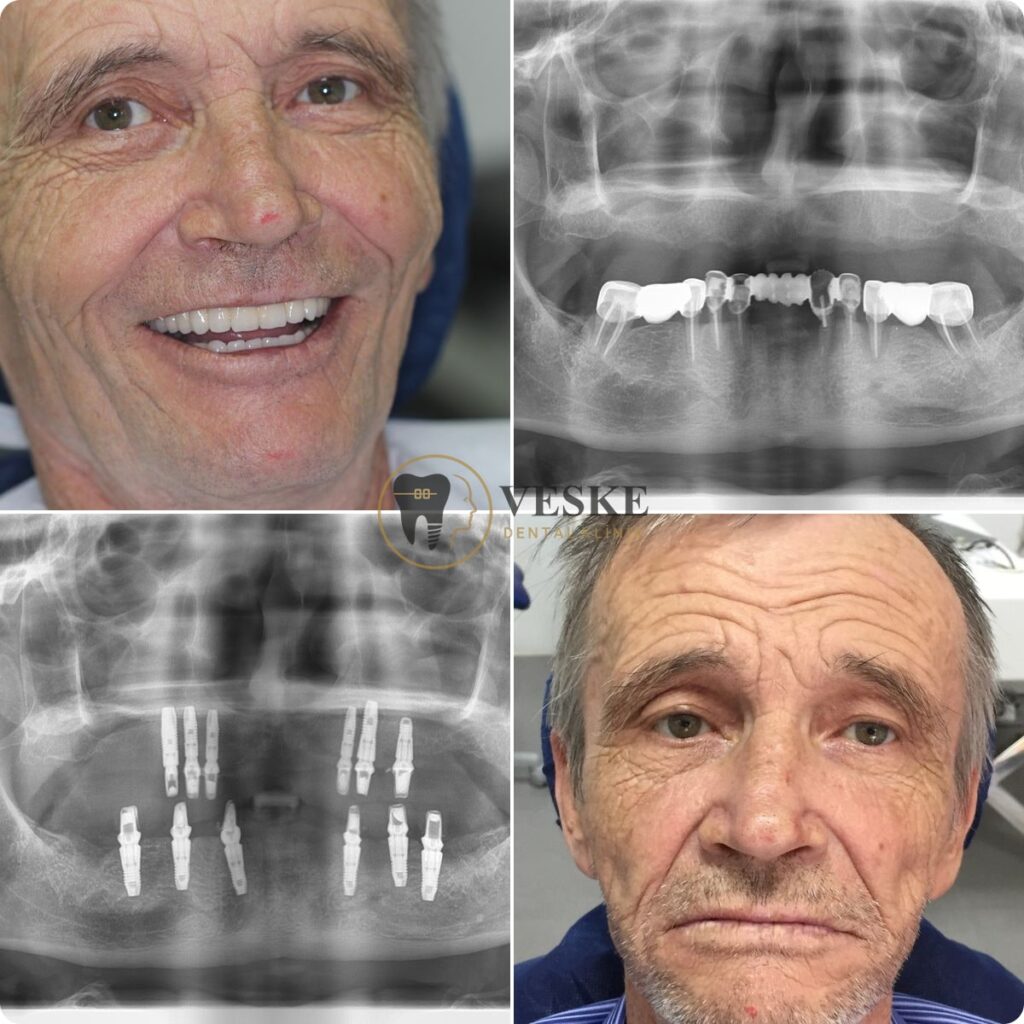 Full jaw dental implant - Veskedent Dental Implant Turkey