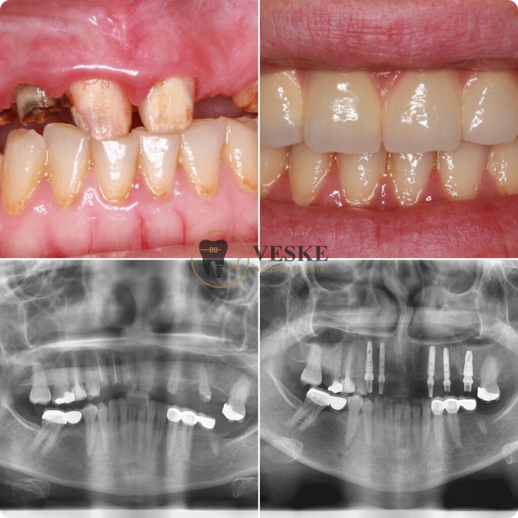 Full upper arch implant - Veskedent Dental Implant Turkey