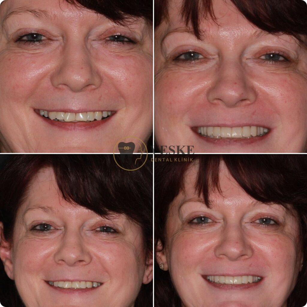 Hollywood smile makeover - Veskedent Dental Implant Turkey