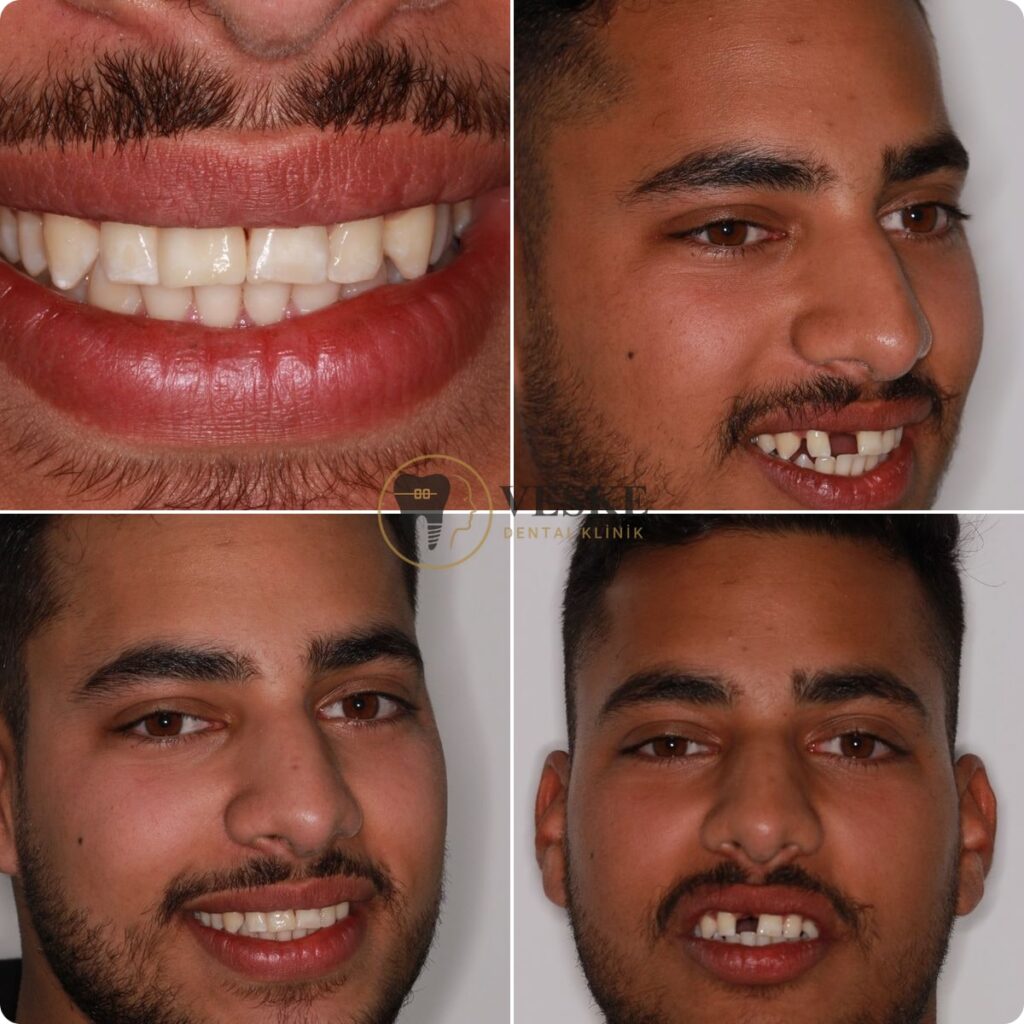 Single tooth implant - Veskedent Dental Implant Turkey