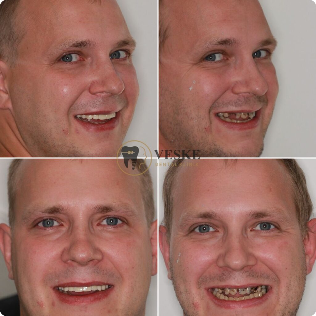 Smile design veneer - Veskedent Dental Implant Turkey