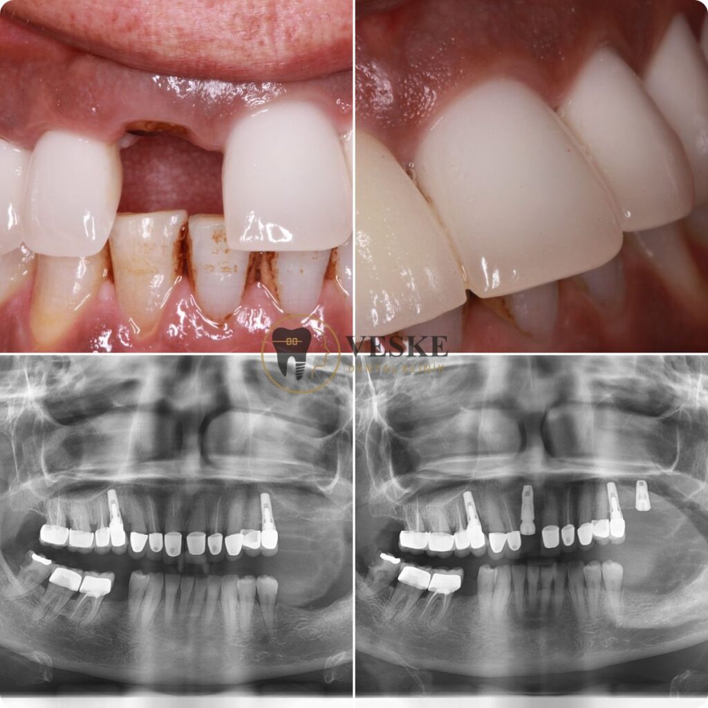 Upper front implant restoration - Veskedent Dental Implant Turkey